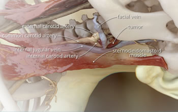 computer aided graphic of carotid artery removal using 3D