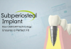 Subperiosteal Implant: How CAD/CAM Technology Ensures a Perfect Fit Subperiosteal Implant