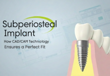 Subperiosteal Implant: How CAD/CAM Technology Ensures a Perfect Fit Subperiosteal Implant