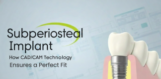 Subperiosteal Implant: How CAD/CAM Technology Ensures a Perfect Fit Subperiosteal Implant